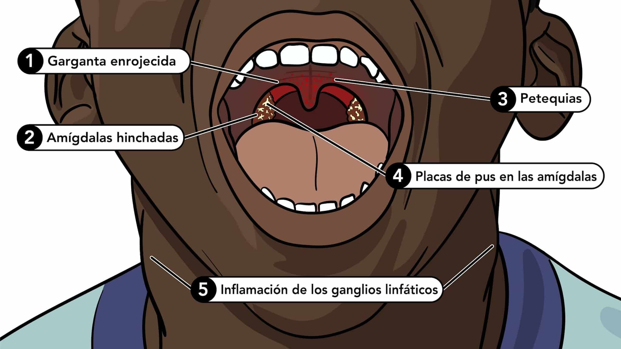 La infección de garganta: su significado espiritual al descubierto